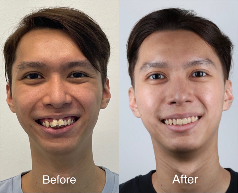 Braces before and after — crowding corrected