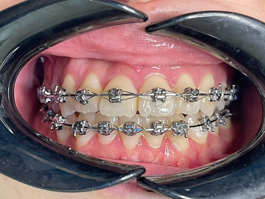 Fixed braces fitted on the upper arch at A M Dental