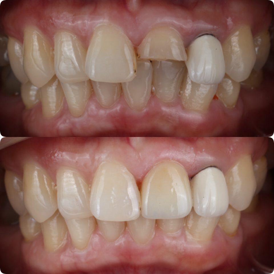 Dental bridge before and after
