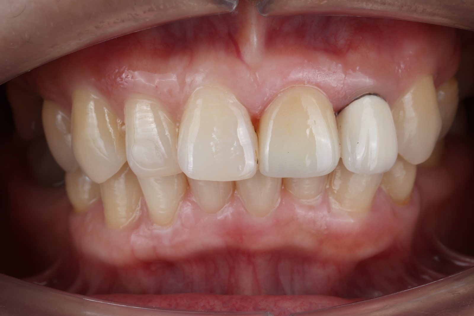 A completed bridge restoring the front teeth