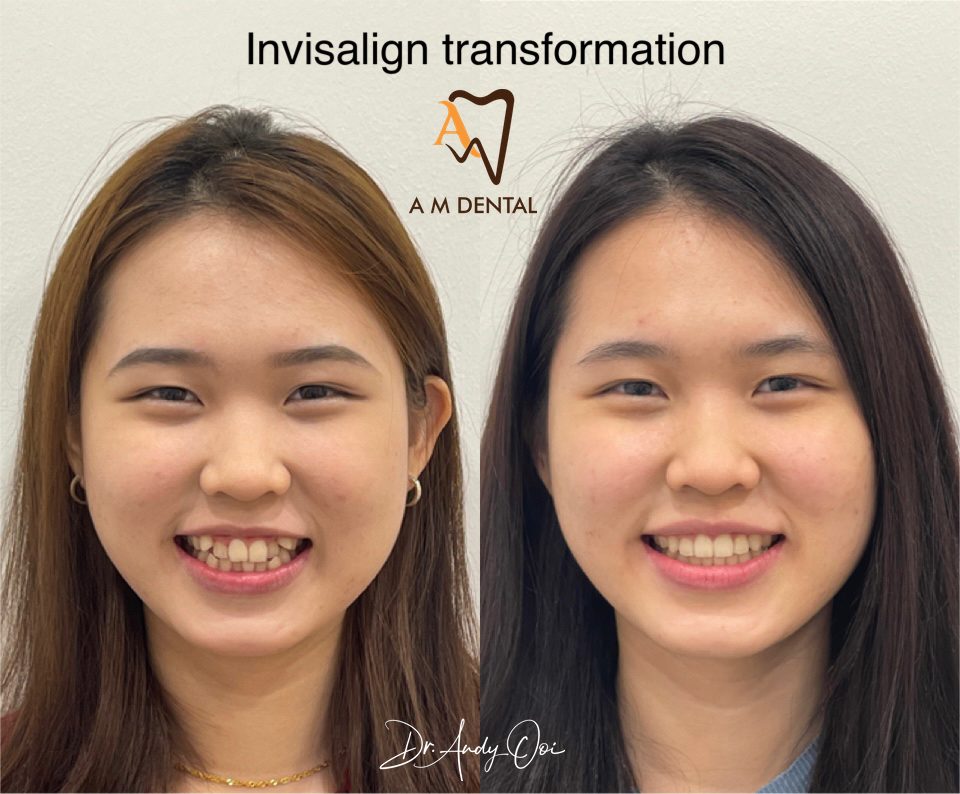 Clear aligner treatment before and after