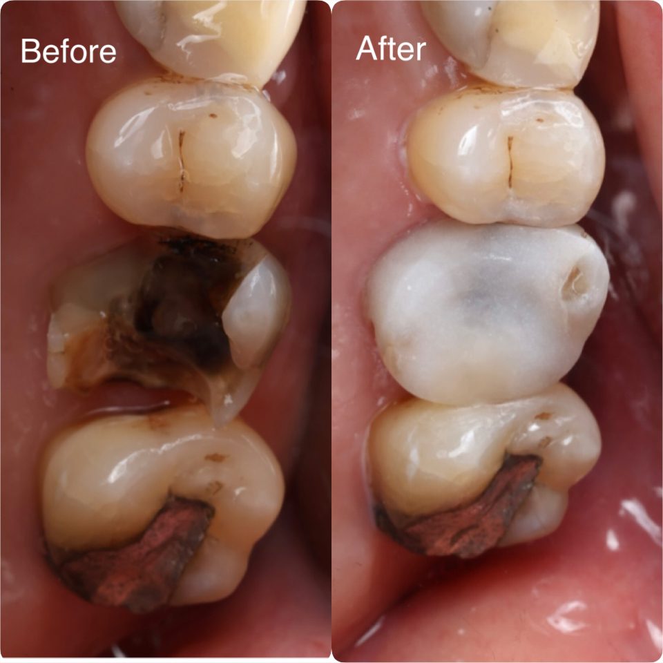 A fractured upper molar restored with a zirconia crown, shaped to look like the original tooth