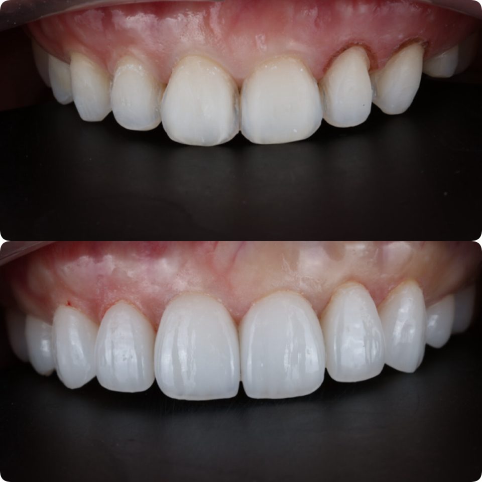 Crowns restoring the upper front teeth