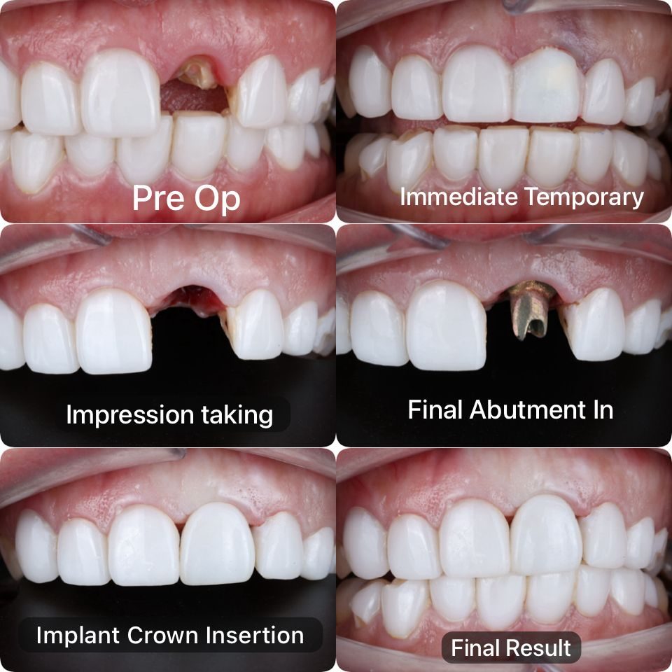 A dental implant from pre-op through to the final crown
