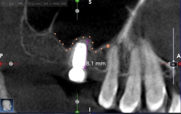 A 3D CBCT scan used for precise planning