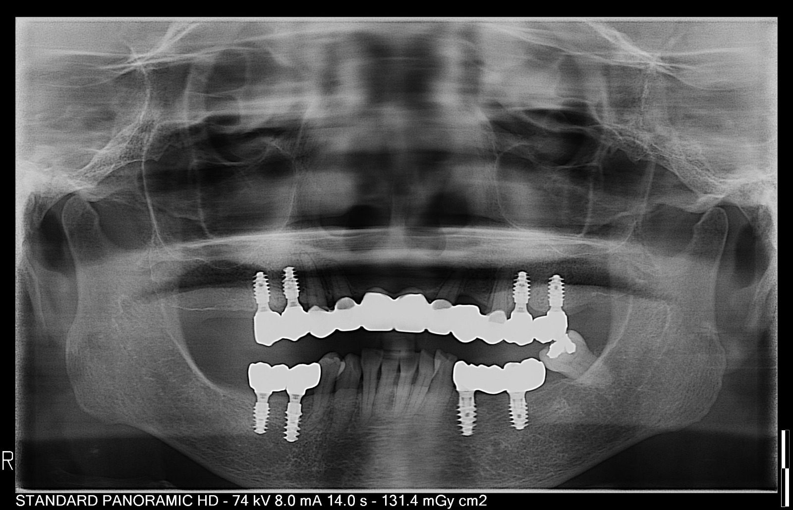 A full panoramic dental X-ray