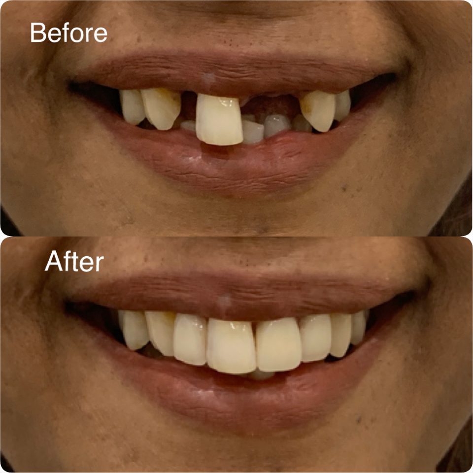 Dentures before and after — a full smile restored