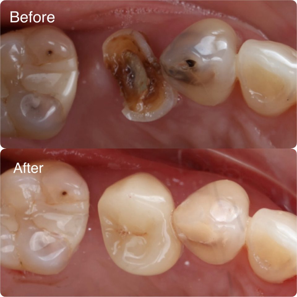 Tooth decay removed and restored with a filling