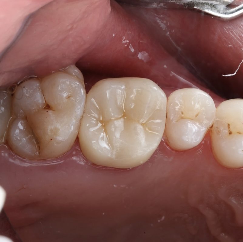 Natural-looking tooth-coloured fillings