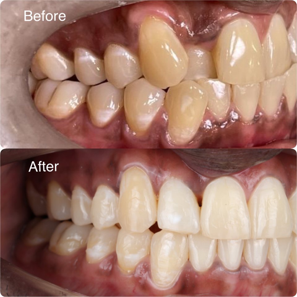 Crowding corrected with clear aligners