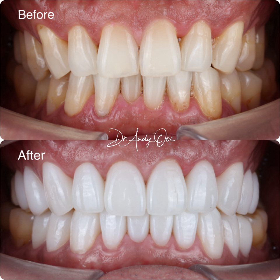A discoloured, uneven smile fully restored