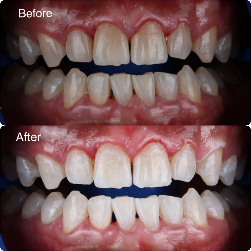 A brighter smile after in-clinic whitening