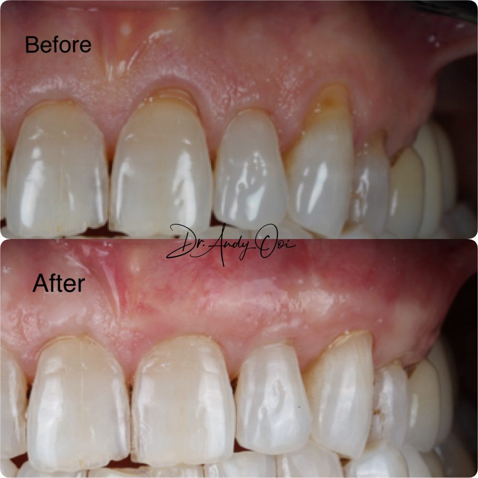 Gum recession treated and covered