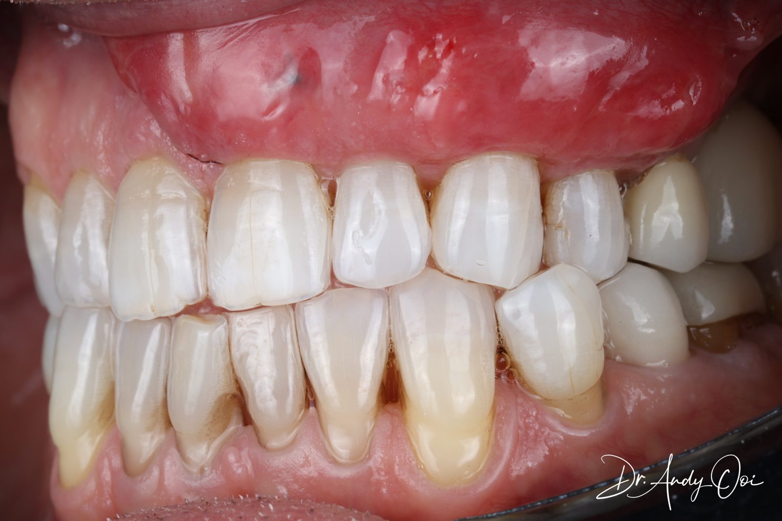 Inflamed gums that need periodontal treatment