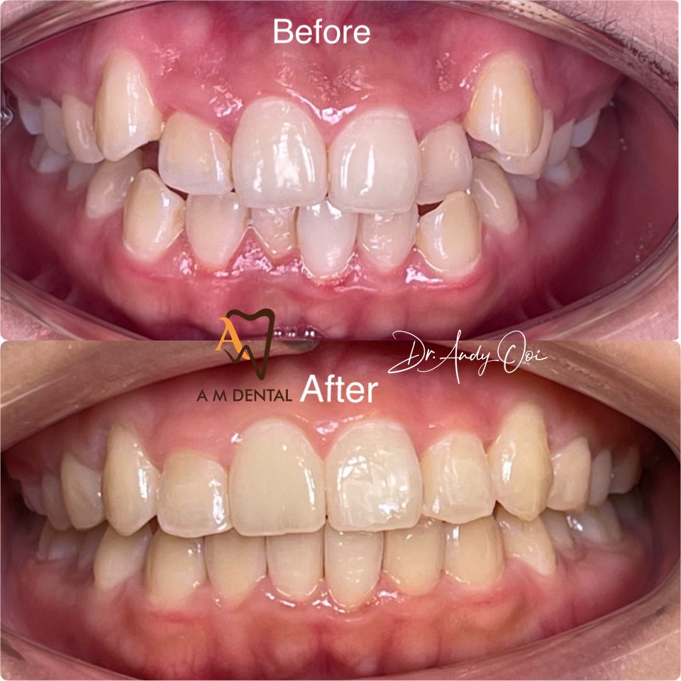 Teeth straightened with clear aligners, before and after