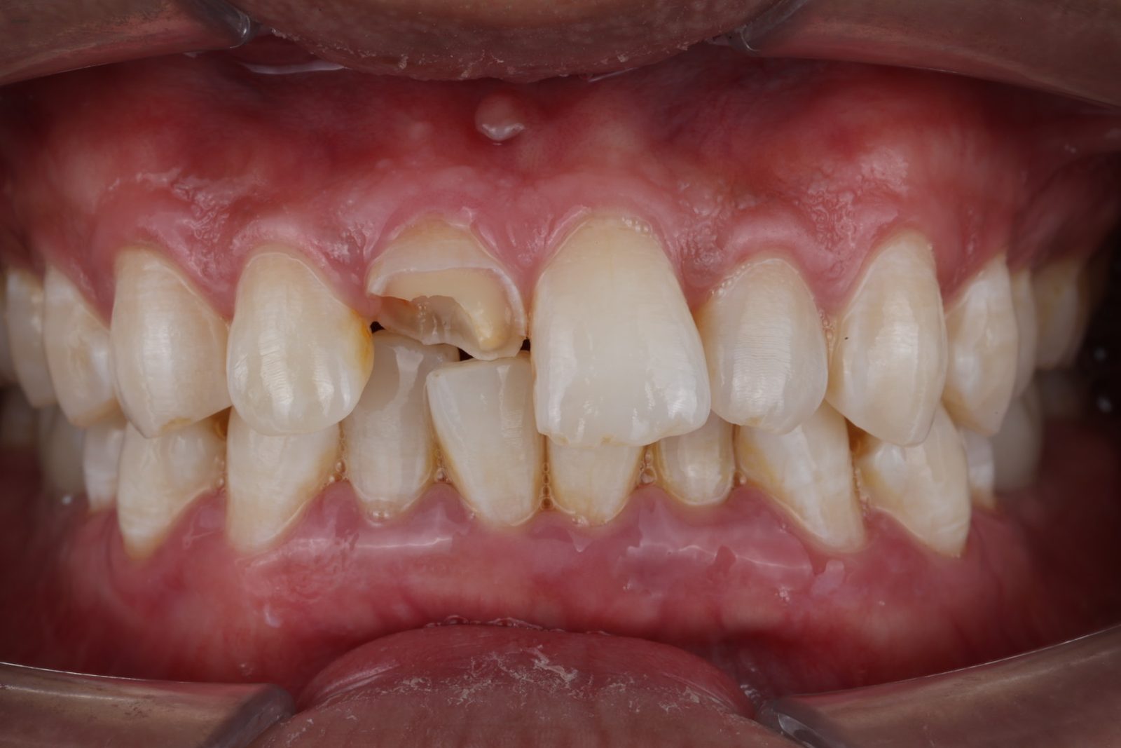 Deep decay that may need root canal treatment