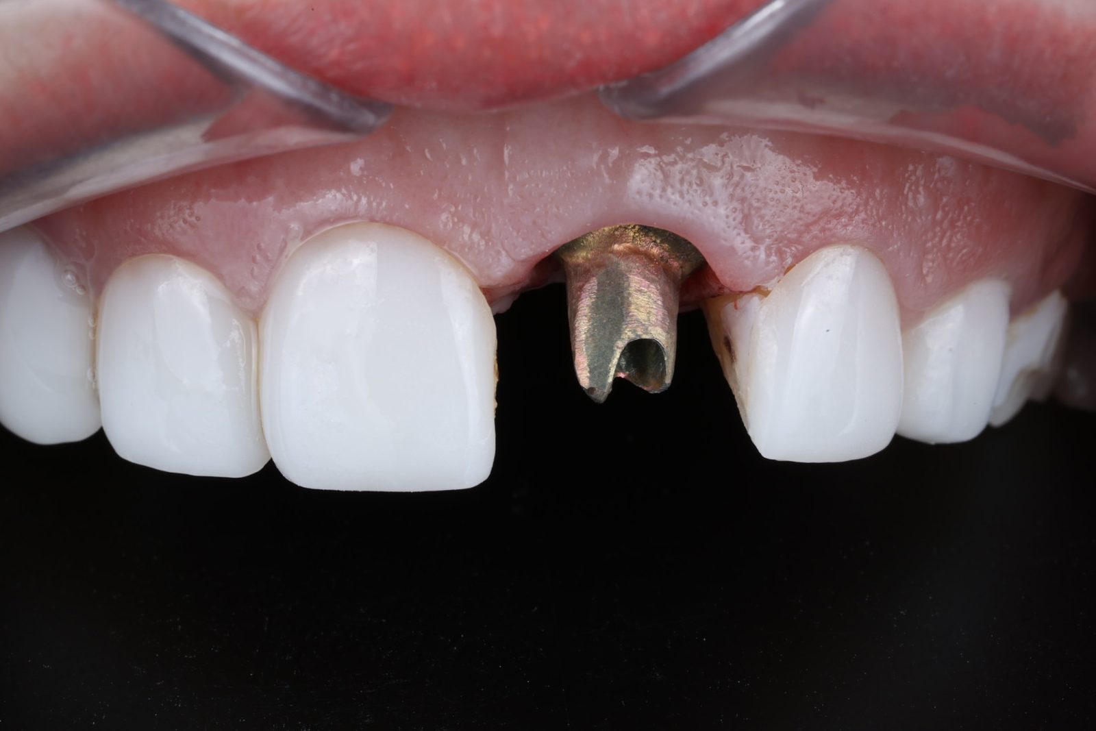 A root-treated tooth prepared with a post and core