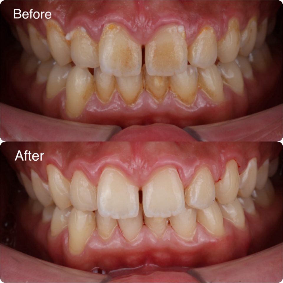 Teeth cleaned and polished at A M Dental