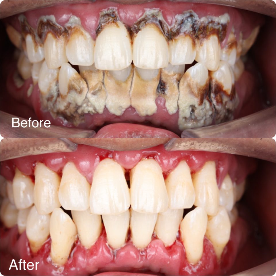 Heavy tartar removed by scaling and polishing