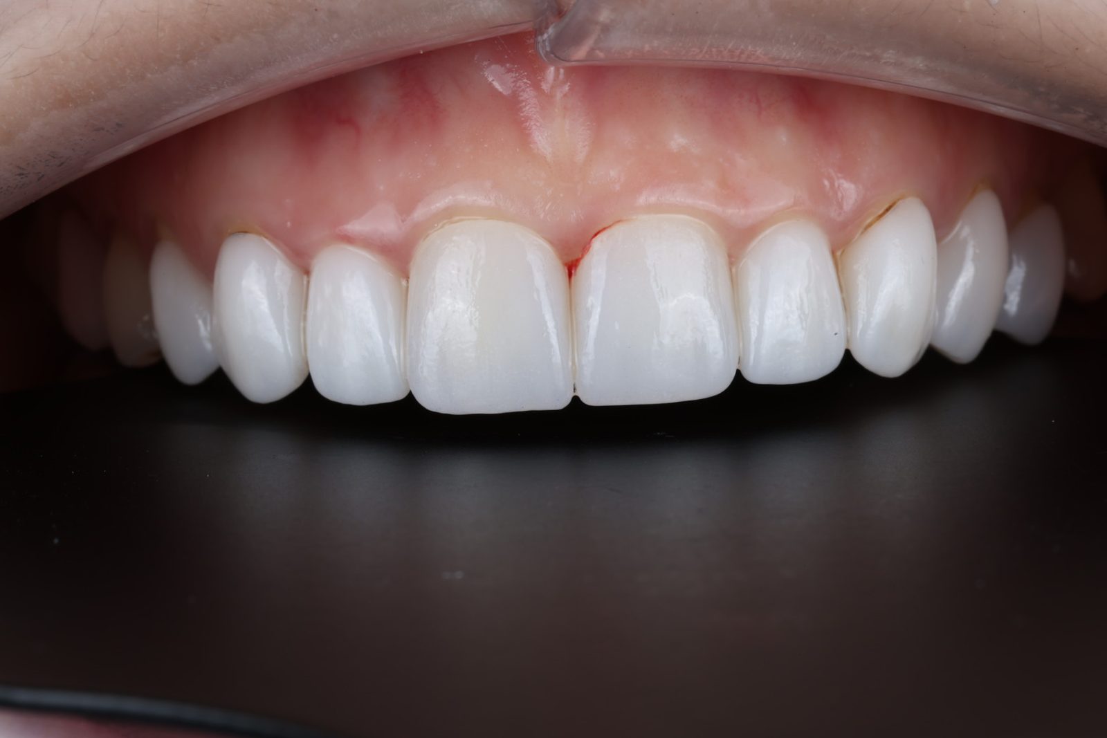 Brighter, refreshed teeth