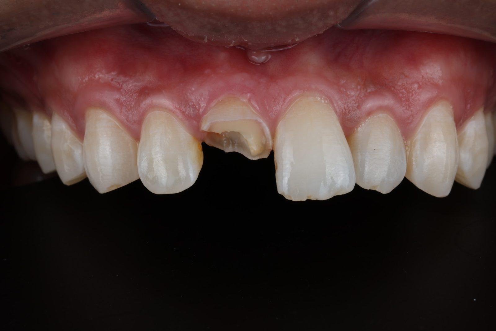 A fractured tooth that could not be saved