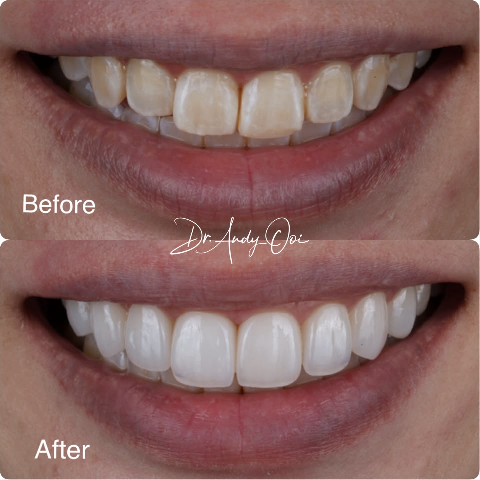 A smile restored with veneers, shown before and after