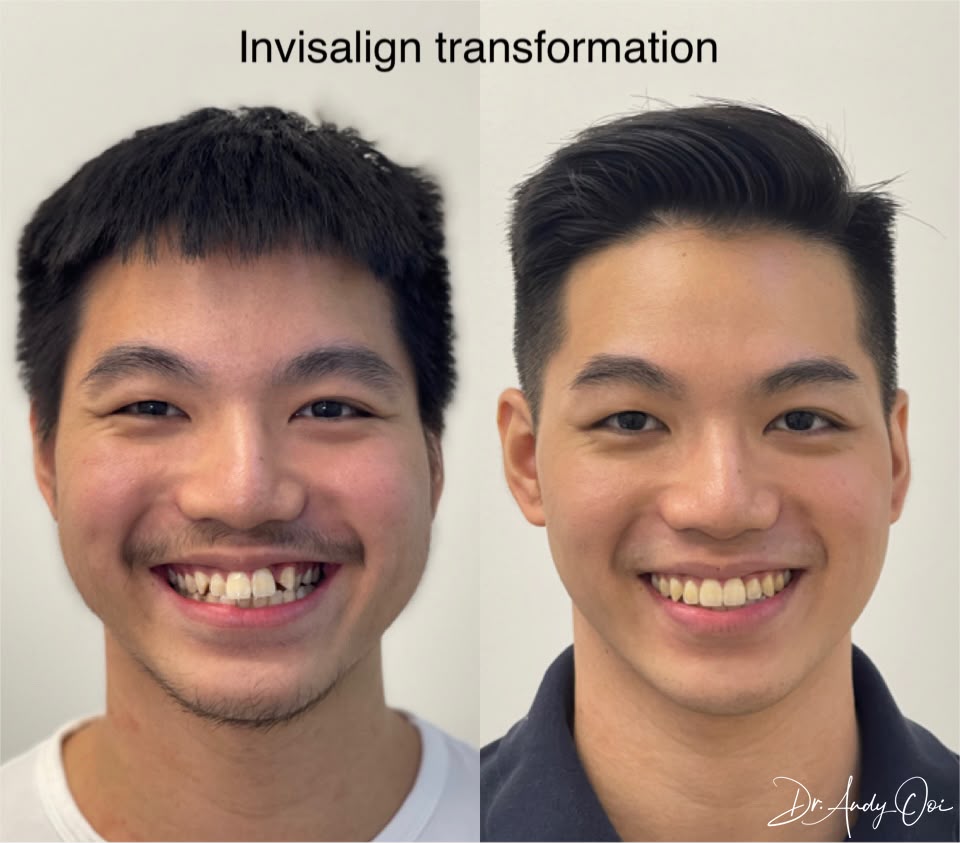 An Invisalign transformation, shown before and after