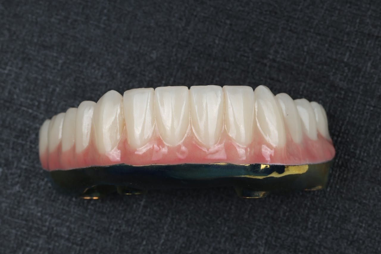 A finished full-arch implant bridge before fitting