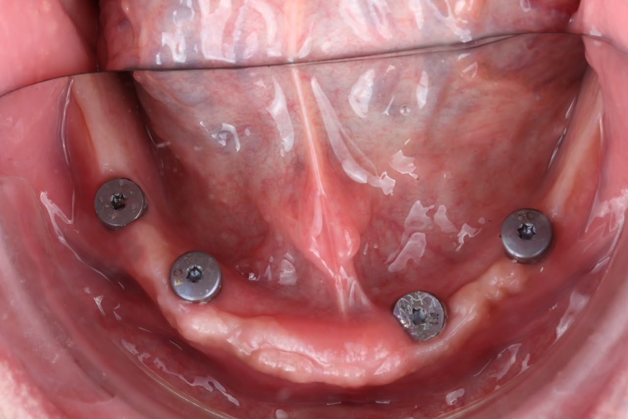Four dental implants with multi-unit abutments placed in a lower jaw