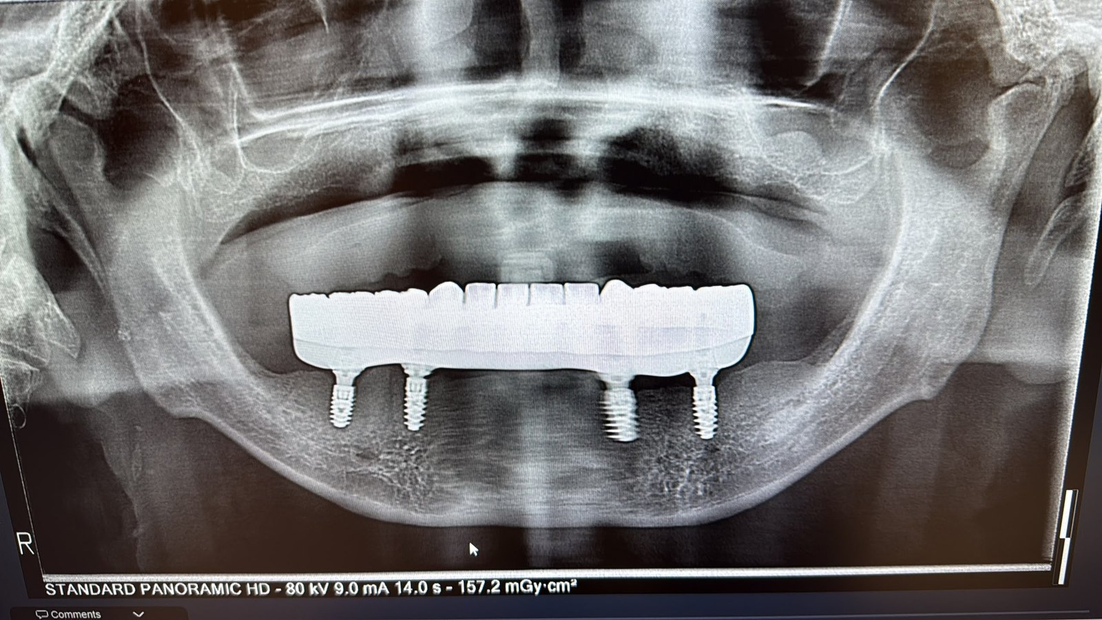Panoramic X-ray showing a full-arch implant bridge in the lower jaw