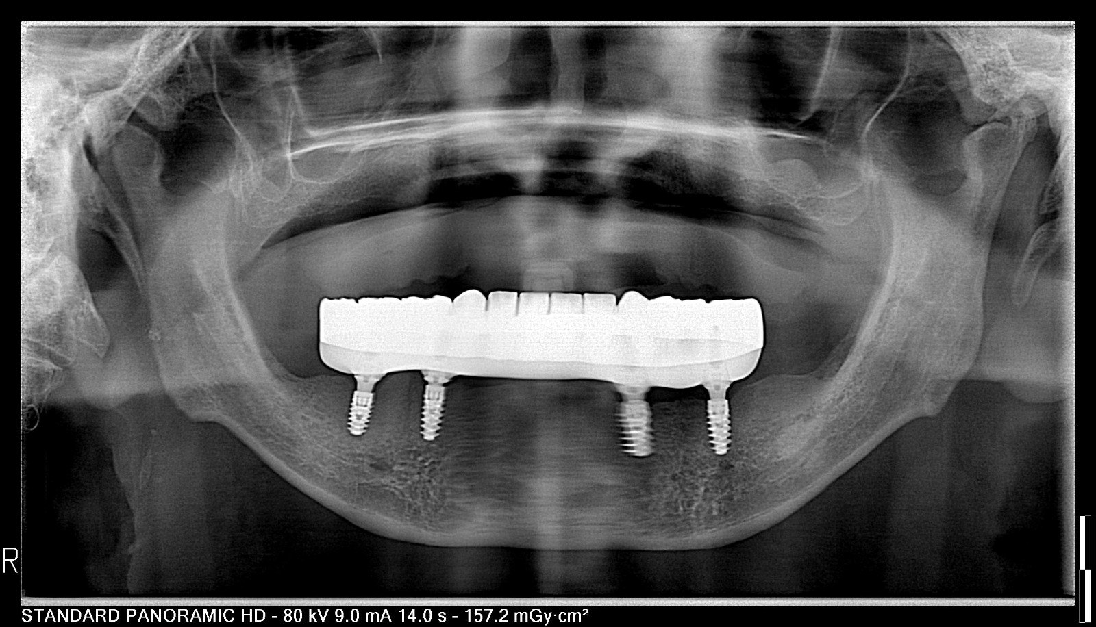 Panoramic X-ray of a full lower arch supported on four dental implants (All-on-X)