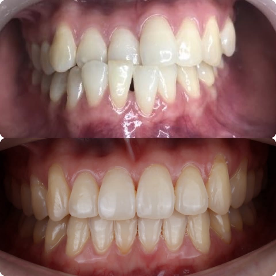 Crowded lower teeth aligned with clear aligners