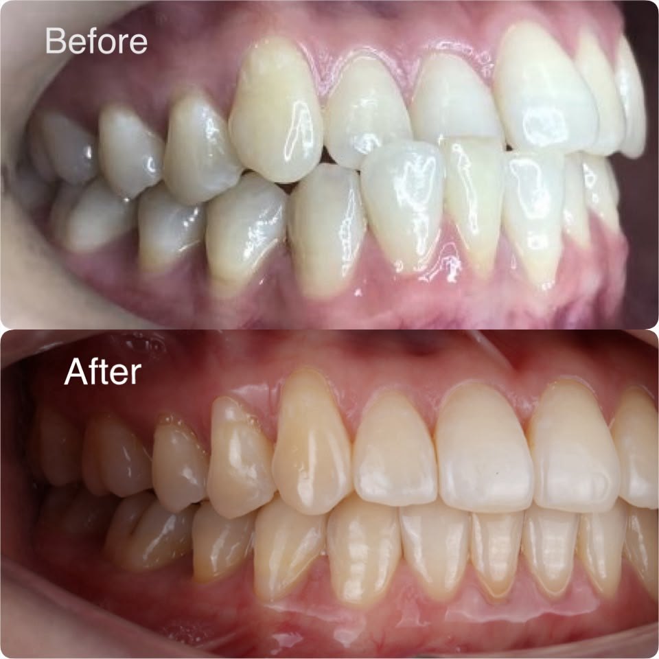 Crowded and rotated teeth aligned with clear aligners