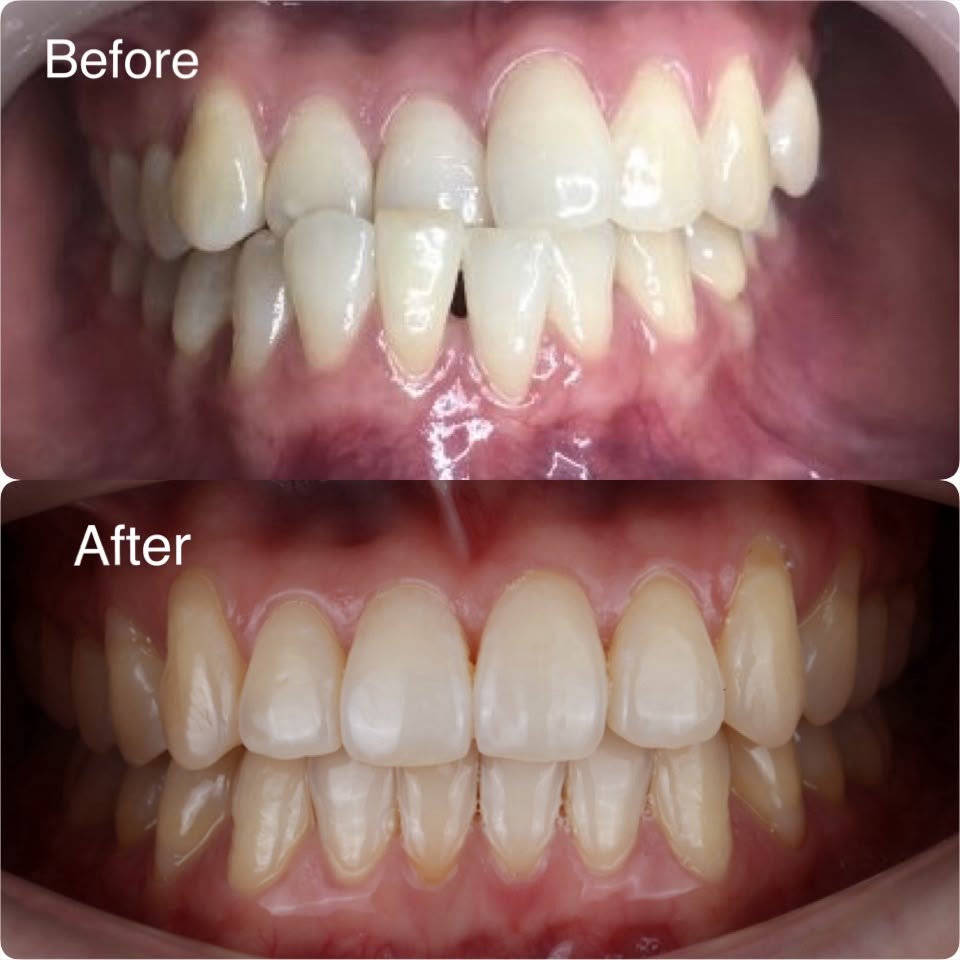 Uneven front teeth straightened with clear aligners