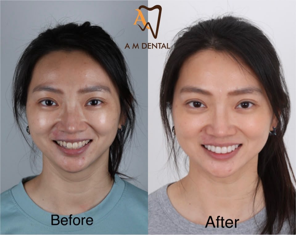 A full smile makeover before and after at A M Dental