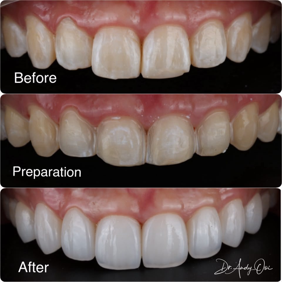 Veneers case shown before, after preparation and after fitting