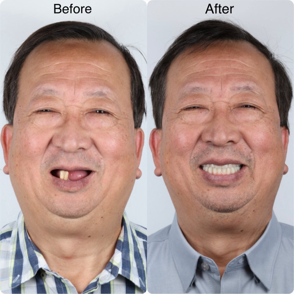 An elderly patient's smile before and after treatment at A M Dental