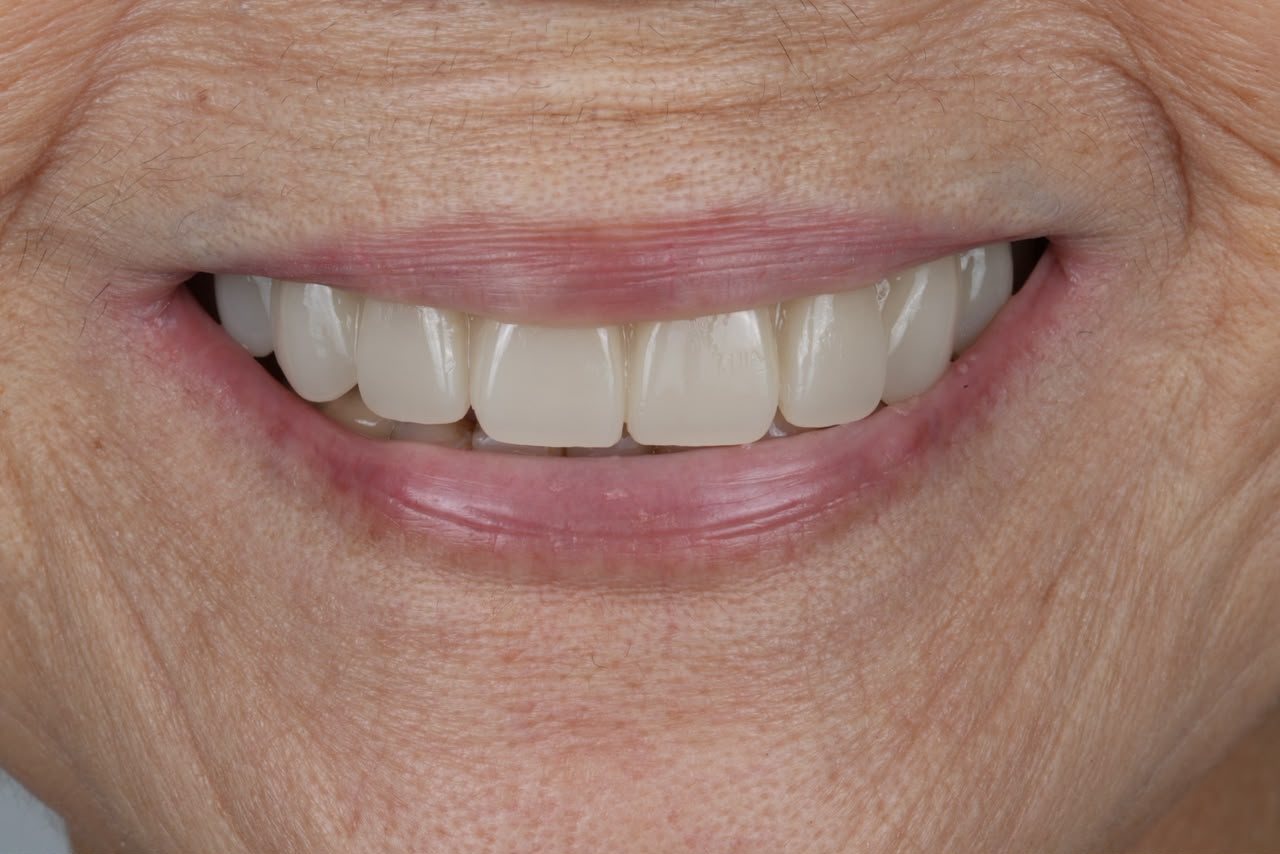 A senior patient's new smile after treatment