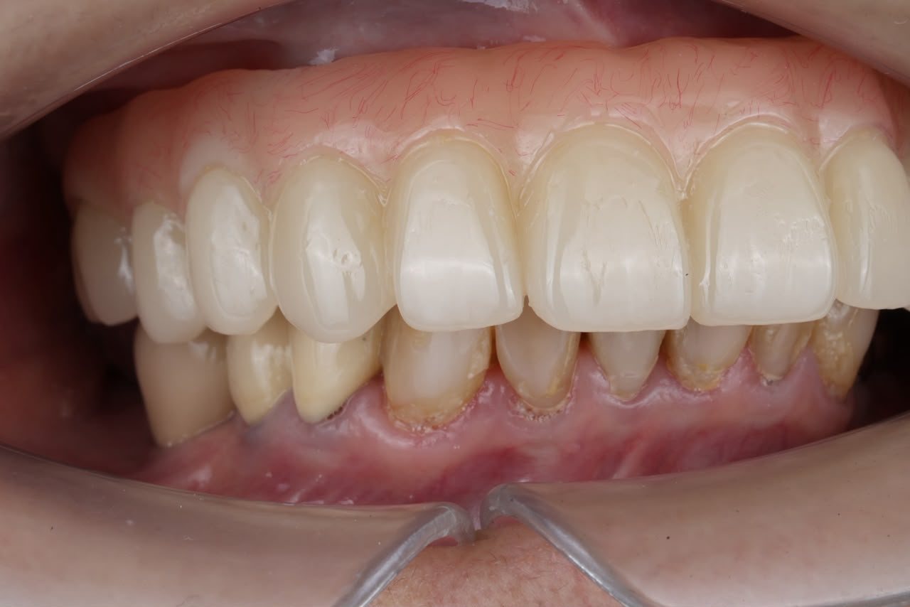 A senior patient's replacement teeth fitted at A M Dental
