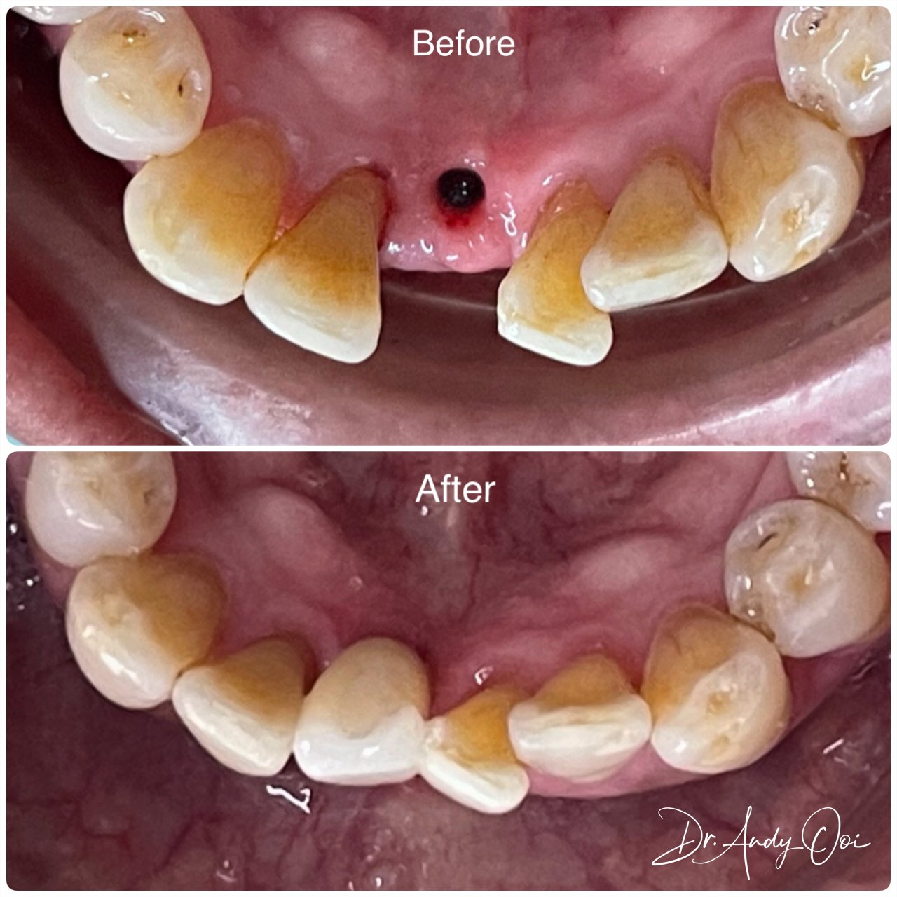 A missing front tooth replaced with a single dental implant