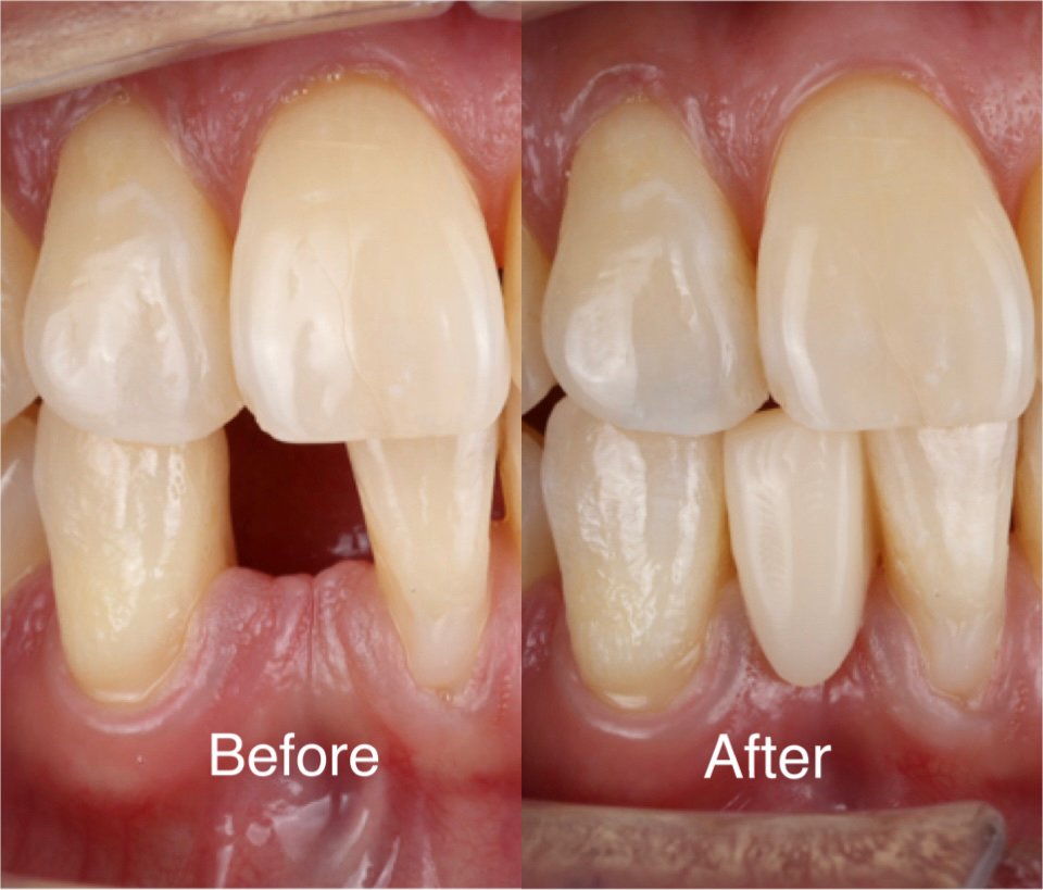 A gap at the front closed with an implant crown