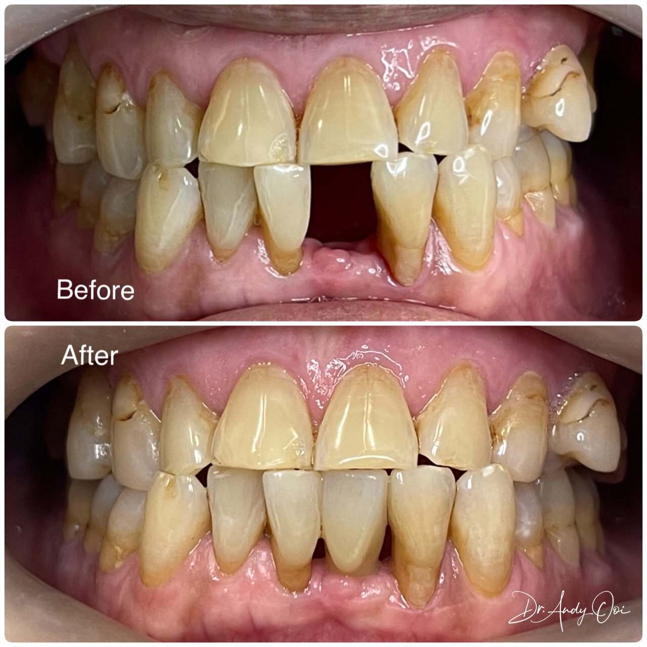 A missing lower incisor replaced with a dental implant