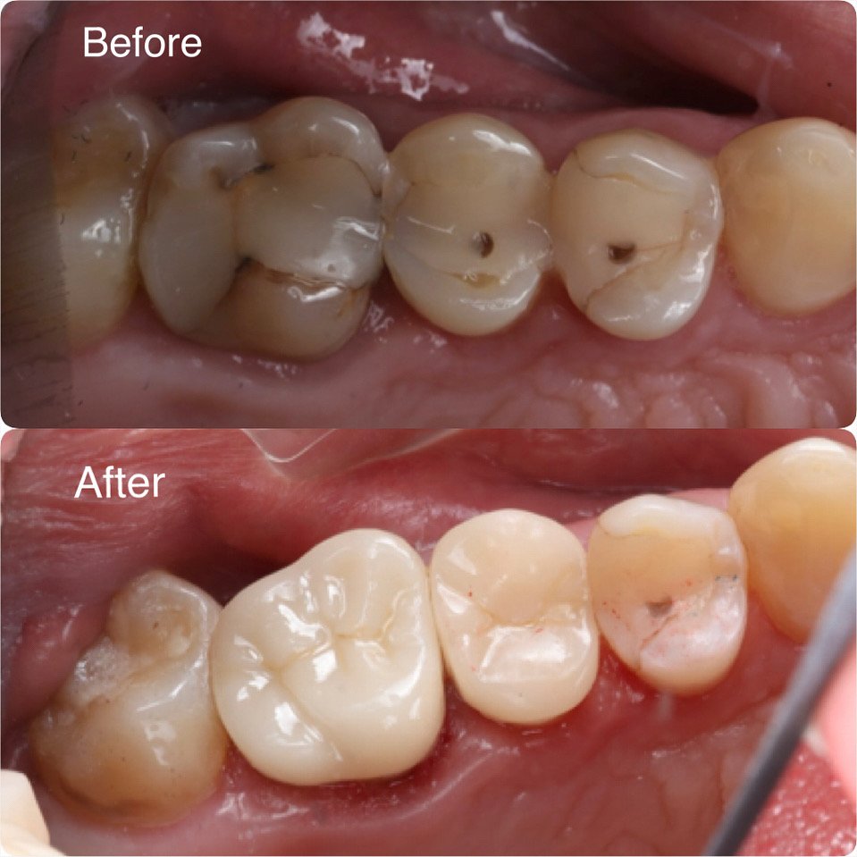 A missing molar restored with an implant crown