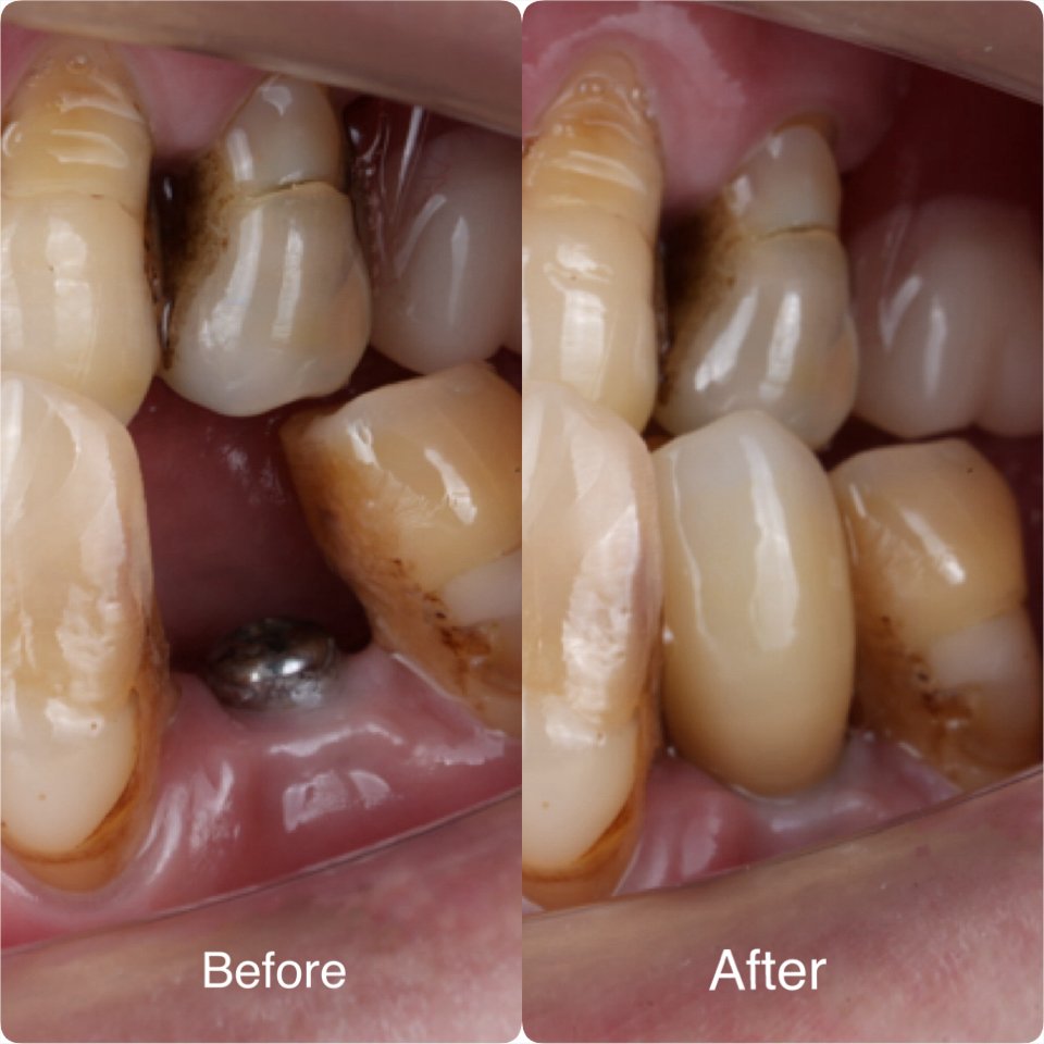 A back tooth replaced with a dental implant