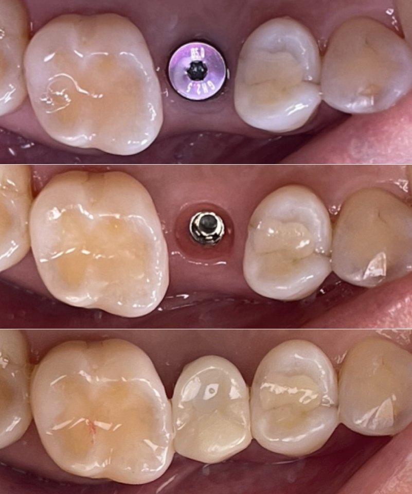 An implant healing abutment, then the finished crown