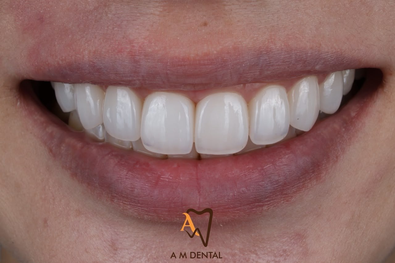 A natural-looking smile after porcelain veneers at A M Dental