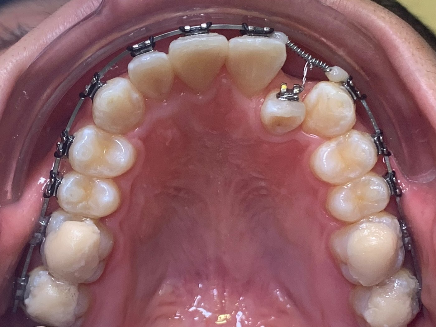 Fixed braces fitted on an upper arch at A M Dental